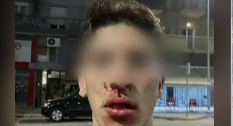 Θεσσαλονίκη: Συγκλονίζει η μαρτυρία του 20χρονου που ξυλοκοπήθηκε από ομάδα 10 ατόμων (Video)