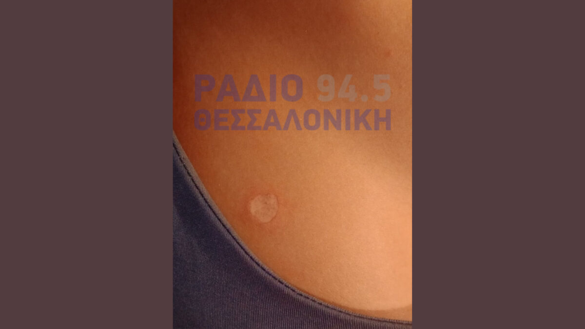 12χρονη έσβησε τσιγάρο στο στήθος 13χρονης- Η μητέρα στο Ράδιο Θεσσαλονίκη (PHOTO&AUDIO)